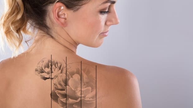 Woman with a shoulder tattoo illustrating laser tattoo removal planning