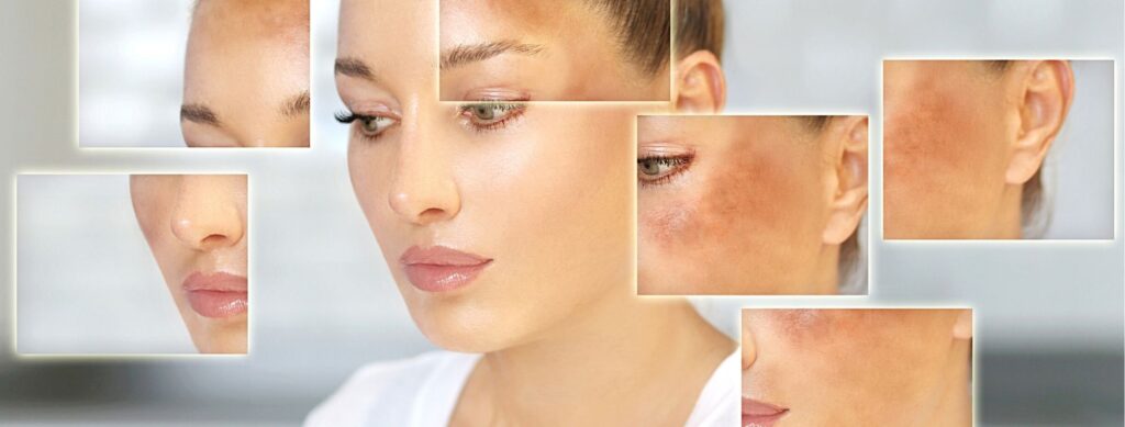 hyperpigmentation treatments that will banish your dark spots forever