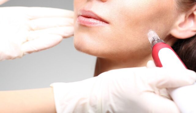 Benefits and side effects of Microneedling treatments
