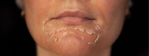  Chemical peel: Facial aesthetics treatment