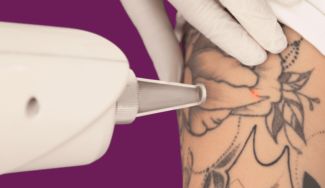 Level 5 Laser Tattoo Removal Training Course