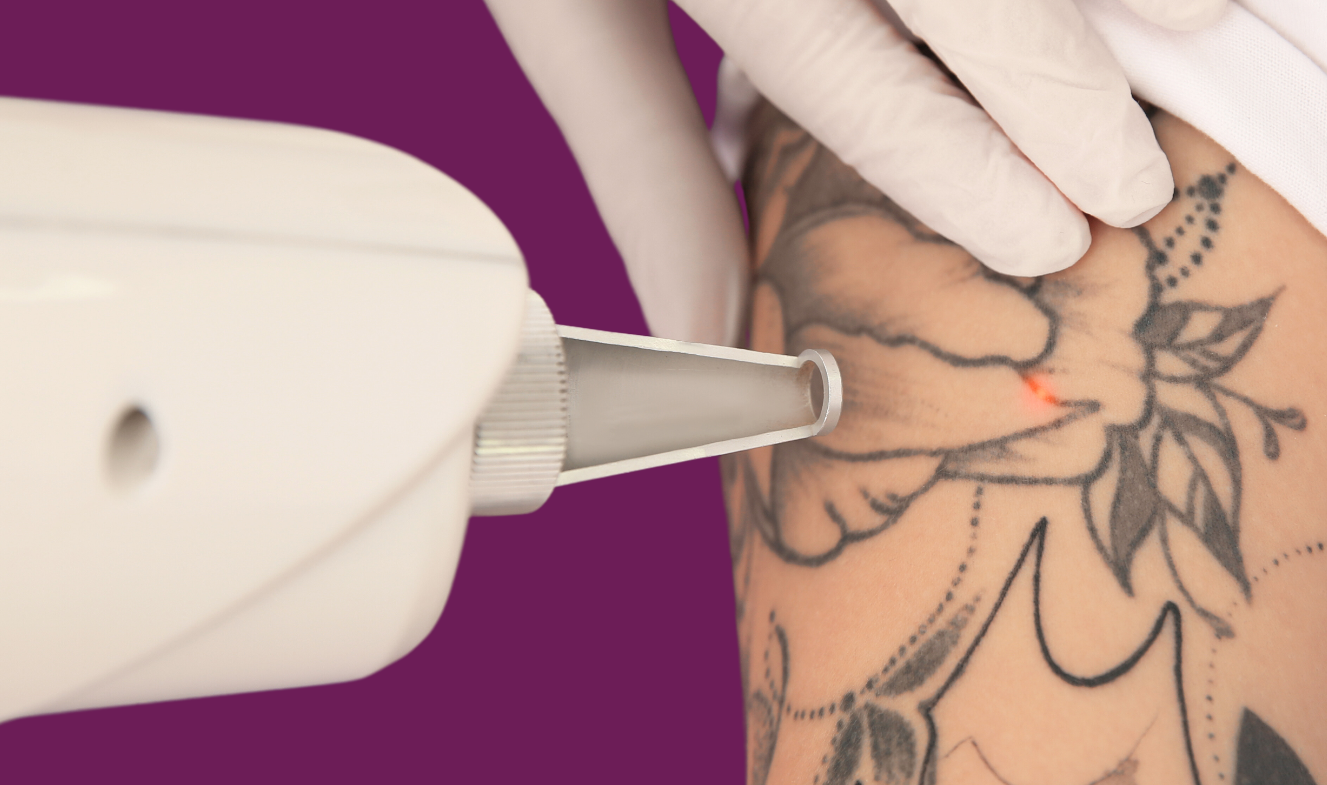 VTCT/ITEC Level 5 Laser Tattoo Removal Certificate Course