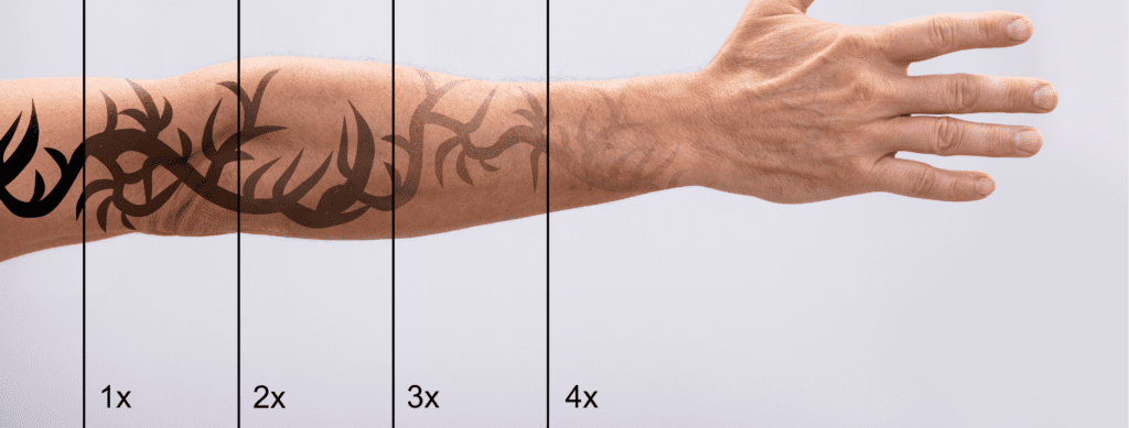 Is Laser Tattoo Removal Painful? – Infinity Laser Spa