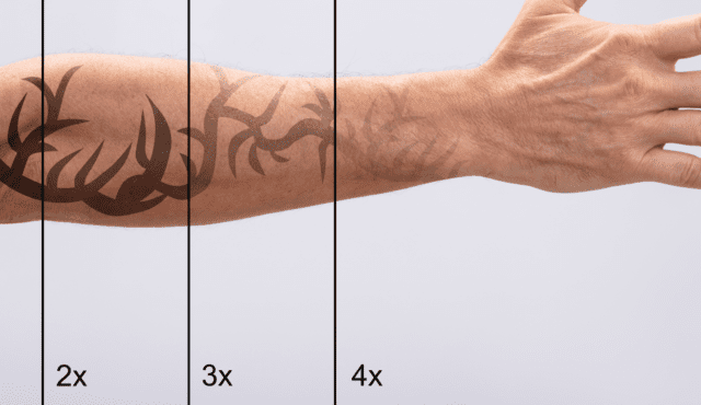 How to become a laser tattoo removal therapist