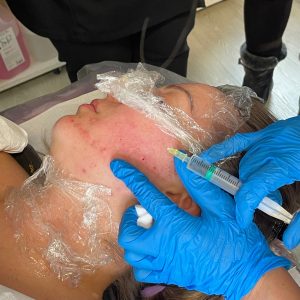 Mesotherapy treatment for skin