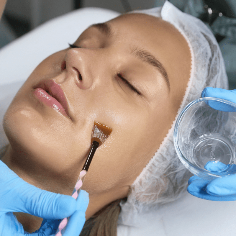chemical skin peels model receiving a treatment