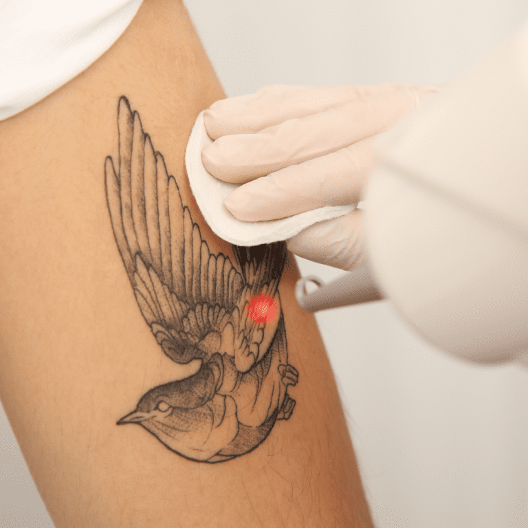 Laser tattoo removal treatment being performed on a tattoo