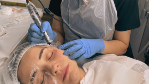 What is Plasma Pen Fibroblast? The long lasting alternative to Botox 