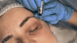 What is Plasma Pen Fibroblast? The long lasting alternative to Botox