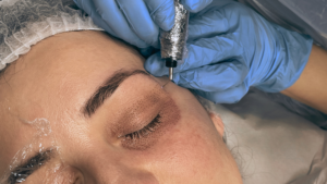 What is Plasma Pen Fibroblast? The long lasting alternative to Botox