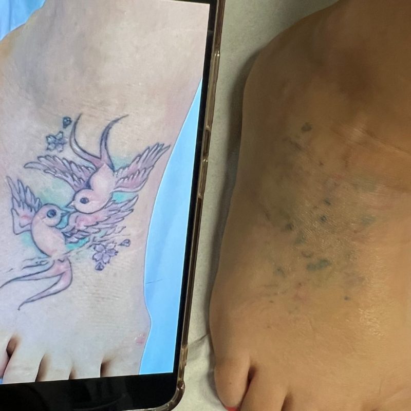 laser tattoo removal results on foot