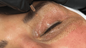 Eye Area Rejuvenation: Plasma Pen (Fibroblast) for Xanthelasma Explained